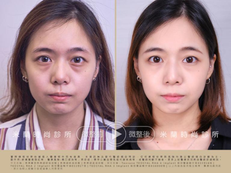 米蘭時尚診所-如何自然消法令紋？靠緹奧希TEOXANE隱形玻尿酸