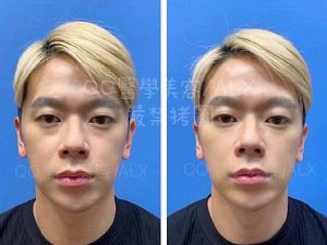 亞立山大時尚整形診所 鄭孝威醫師-淚溝不見？好厲害！TEOXANE玻尿酸