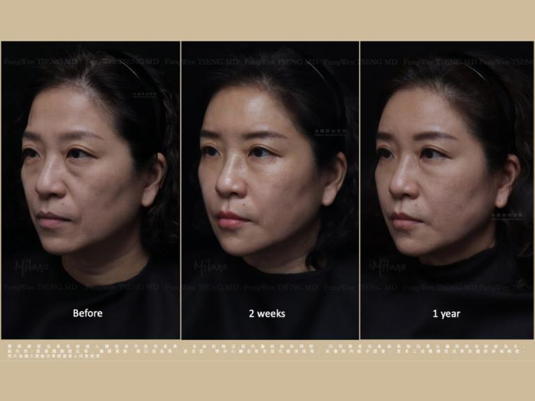 米蘭時尚診所-隱形玻尿酸把媽咪變姊姊，效果維持一年依然閃亮動人！