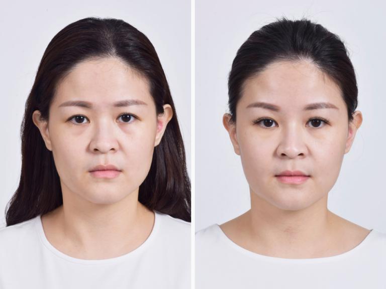 案例 B 小姐